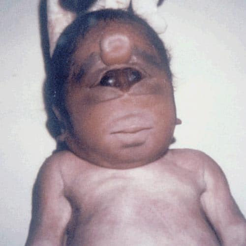 Strangest Birth Defects